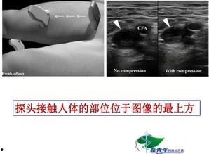 穿刺阴茎在线视频,专业视角下的医学解析